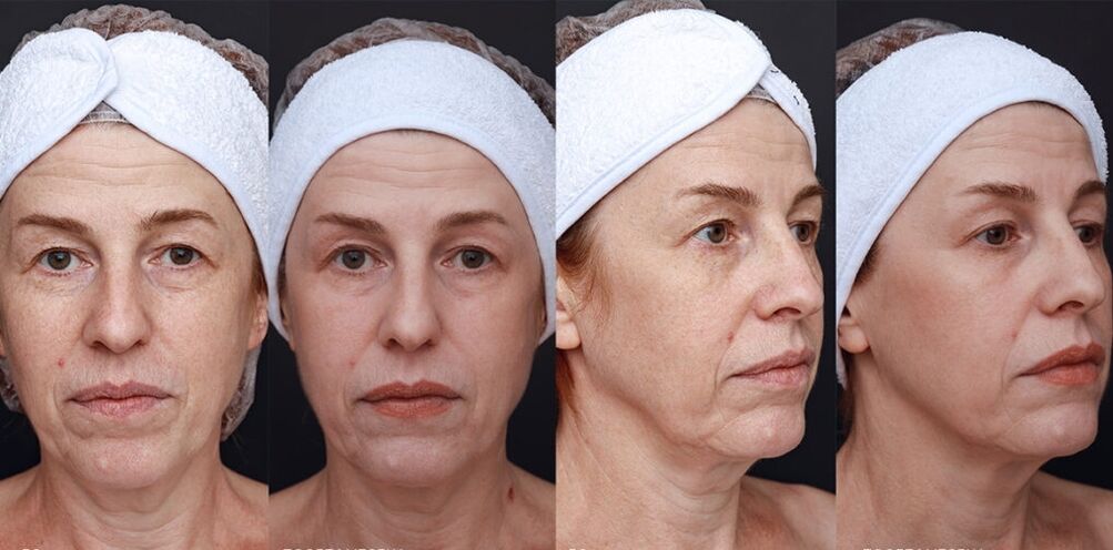 result of cosmetic procedures